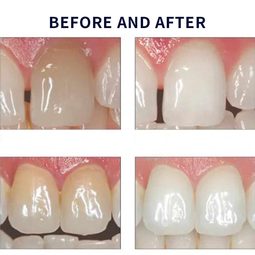 Opalescence Whitening 20% PF 2 - Teeth Whitening Gels Used By Dentists 评论和价格