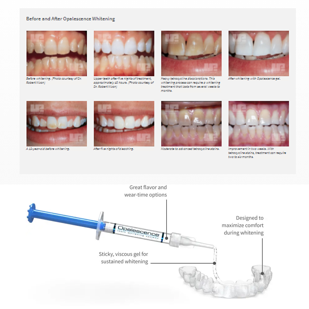 Opalescence Whitening 20% PF 2 - Teeth Whitening Gels Used By Dentists 评论和价格