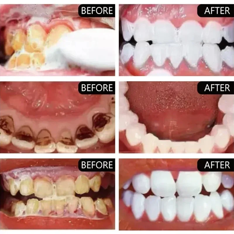 Fast Remove Smoke Stains Tooth - Teeth Whitening Fast 评论和价格