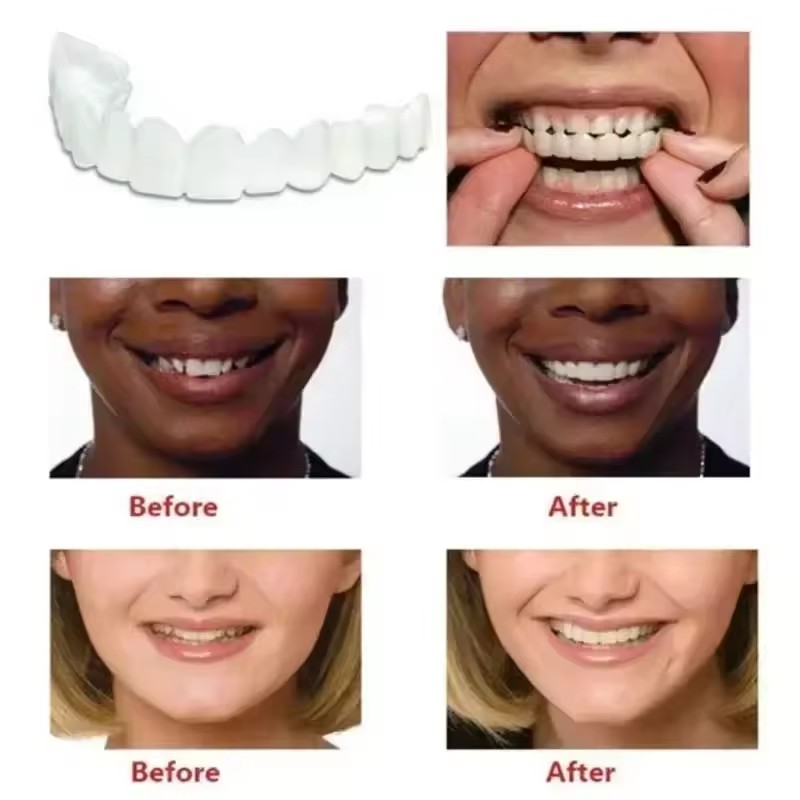 Teeth Veneers Whitening Dentur - Teeth Whitening With Braces 评论和价格