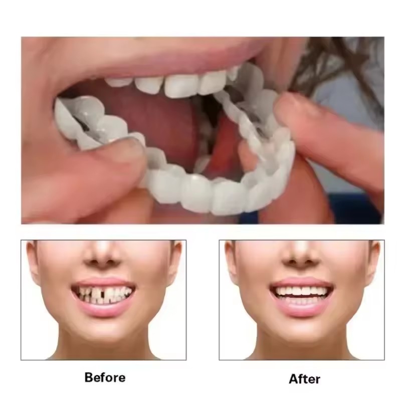Teeth Veneers Whitening Dentur - Teeth Whitening With Braces 评论和价格