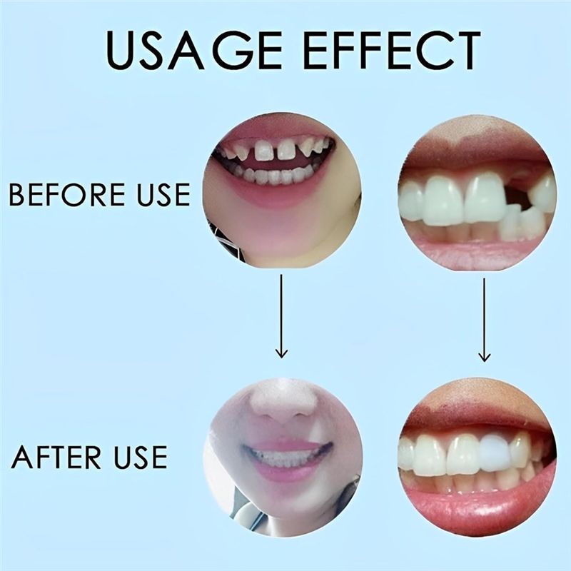 [NEW!ABMK】 2 Pairs,Regain Beau - Teeth Whitening With Braces 评论和价格